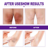 EELHOE Rejuvenator Areola Intimate Area Rejuvenator Lip Joints Melanin Removal